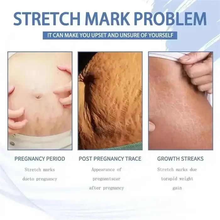 Crème anti-vergetures, lignes lumineuses, obésité post-partum, grossesse, Absorption rapide puissante