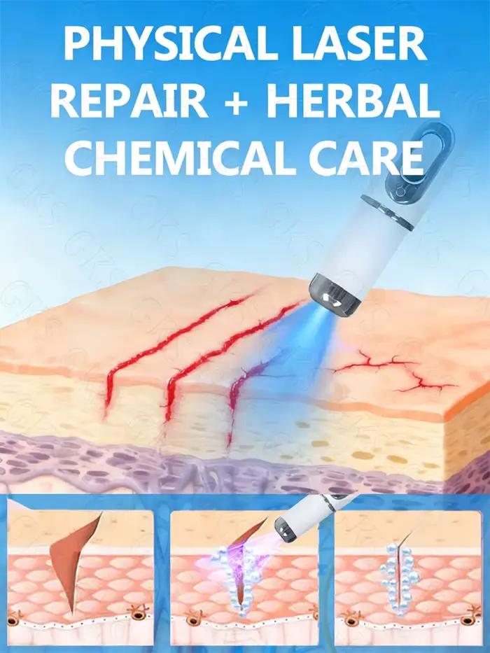 Traitement laser avancé pour les vergetures - adapté à tous les types de peau